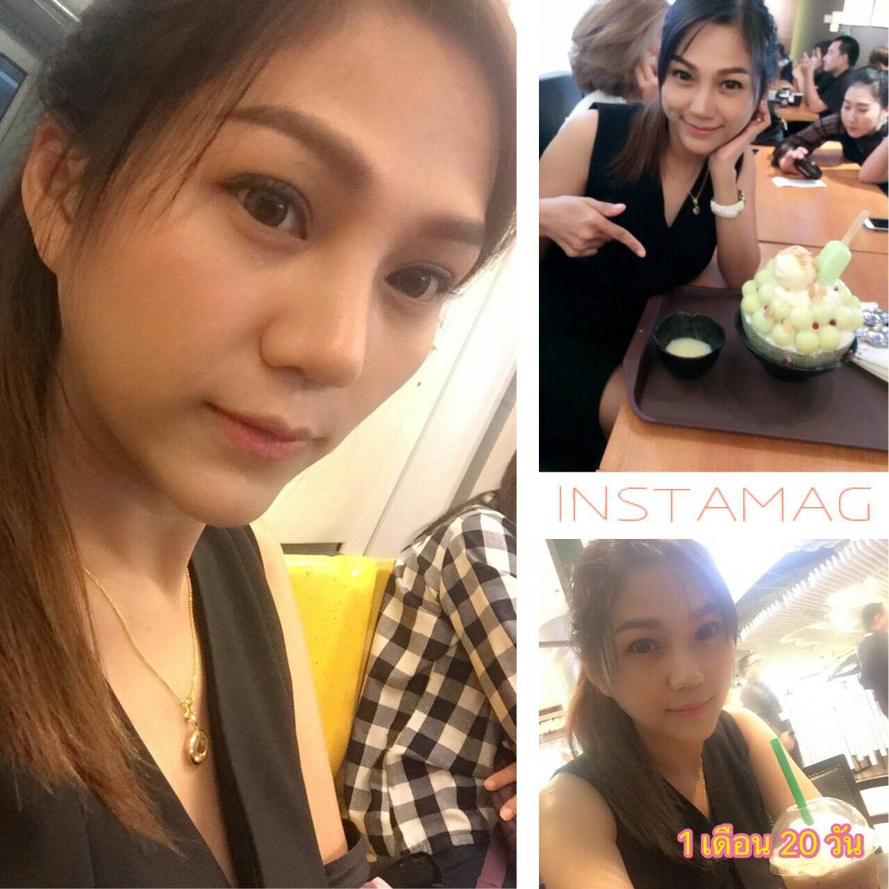 N8 ศัลยกรรมจมูก ทำนม หมอนพรัตน์