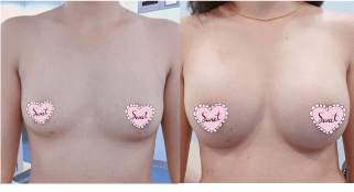 เสริมหน้าอก 345cc ใช้เทคนิคเสริมใต้กล้ามเนื้อ ซิลิโคนทรงหยดน้ำ