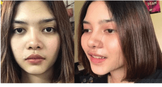 รีวิวเสริมจมูกใช้กระดูกหลังหูเสริมปลาย และตัดปีกรูปหลังทำ 1 ปีค่ะ