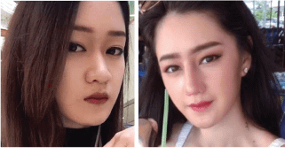รีวิวเสริมจมูก ตัดปีก และใช้กระดูกหลังหูเสริมปลายรูปหลังผ่าตัด 2อาทิตย์