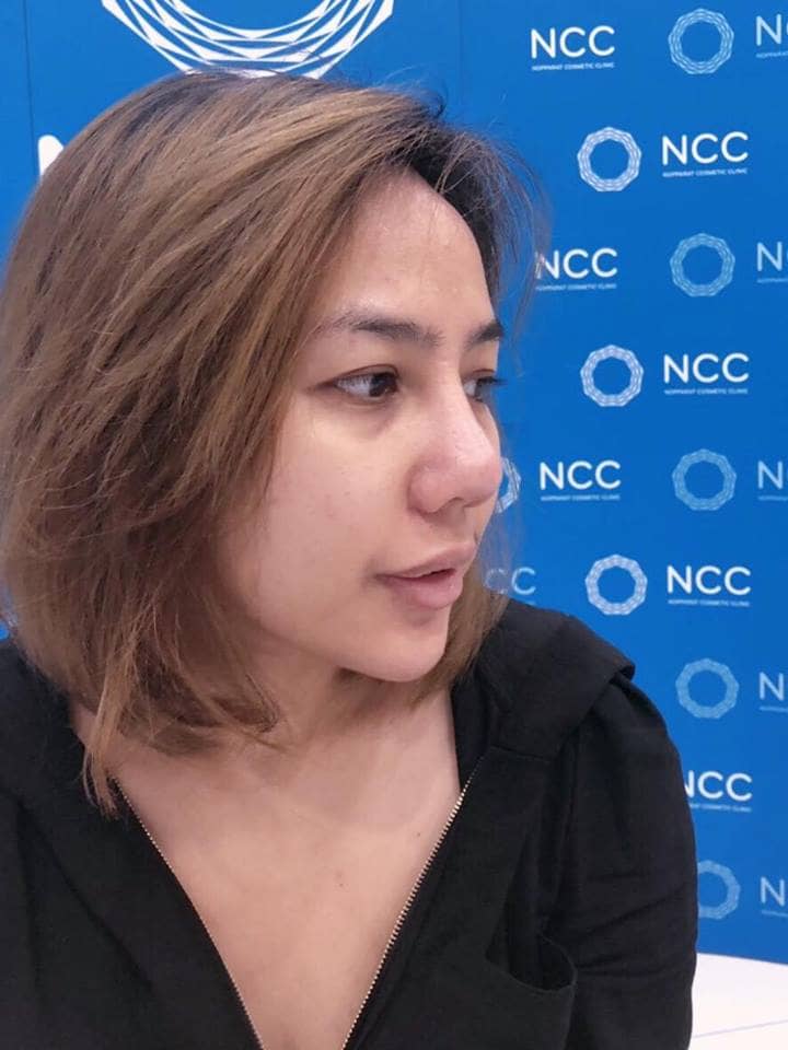 5894901398977380352_n ศัลยกรรมจมูก ทำนม หมอนพรัตน์