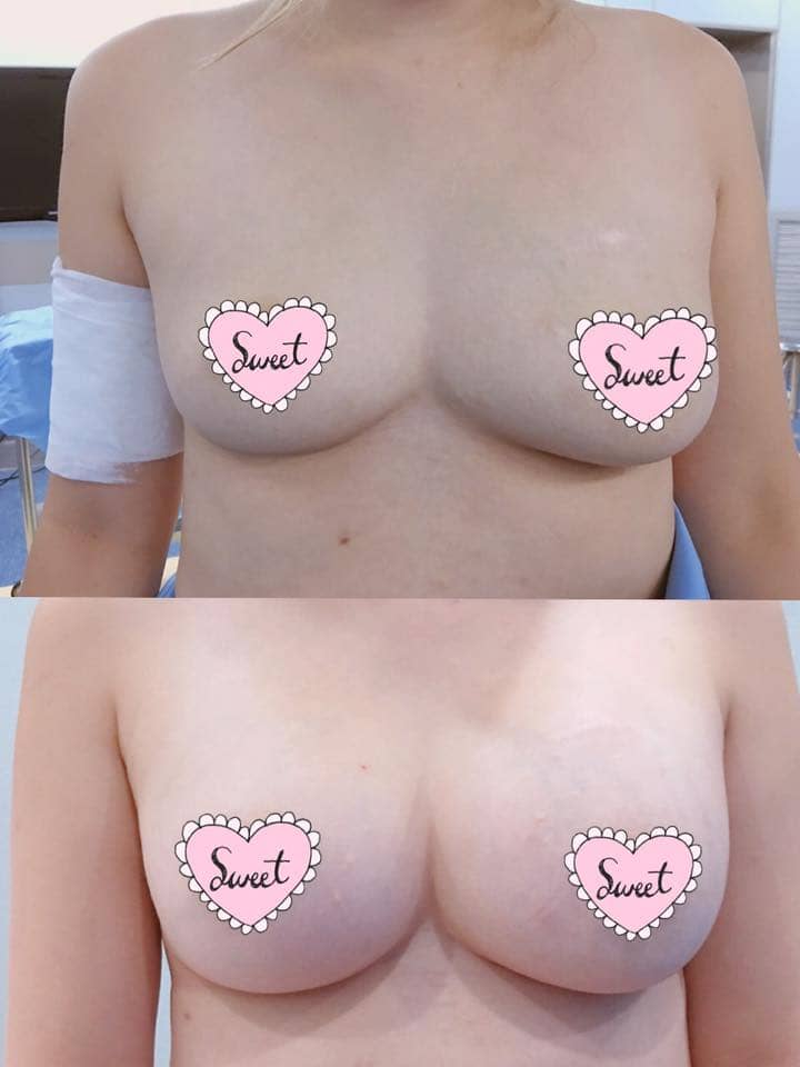6215107062943490529_n ศัลยกรรมจมูก ทำนม หมอนพรัตน์