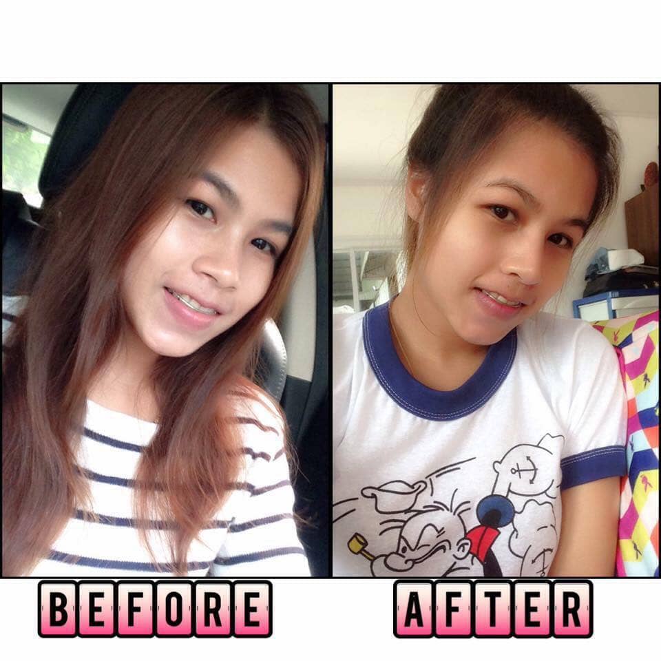 479233181032120320_n ศัลยกรรมจมูก ทำนม หมอนพรัตน์